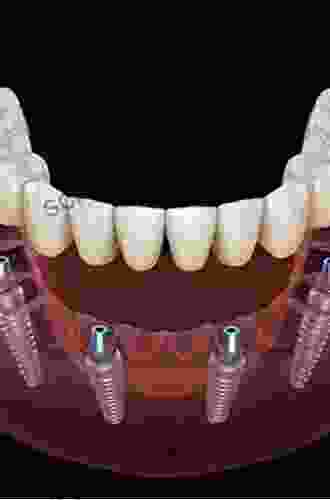 Dental Implant Prosthetics E